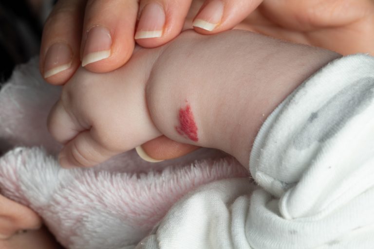 Braço de um bebê com uma mancha vermelha
