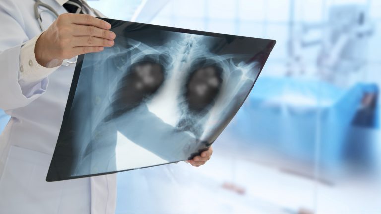 Médico examina um raio-x de pulmão
